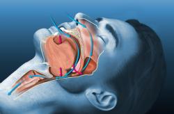 Obstructive Sleep Apnea Awareness